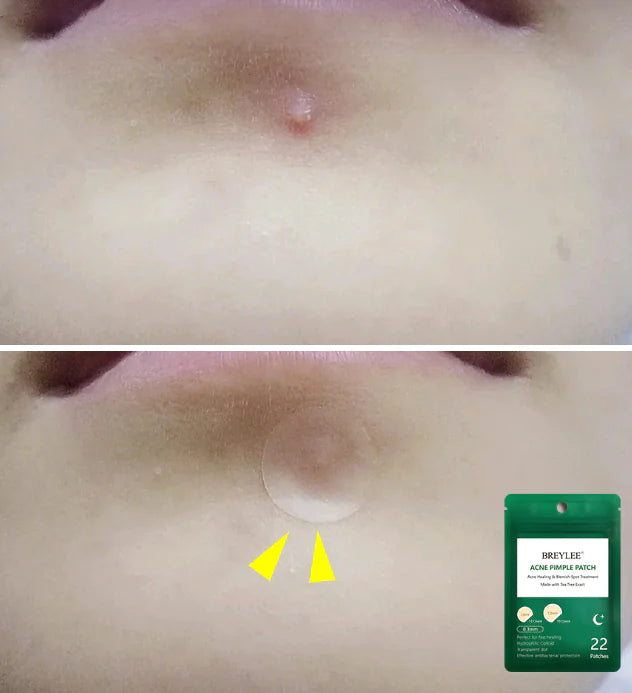 Overnight Acne Patches for Clear Skin