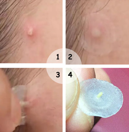 Overnight Acne Patches for Clear Skin